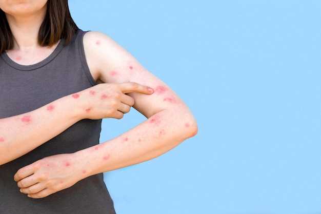 Lisinopril and other treatments for eczema