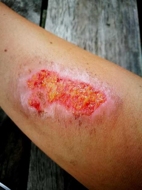 The Role of Lisinopril in Psoriasis Treatment
