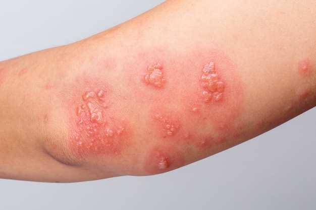 What is a Red Rash?
